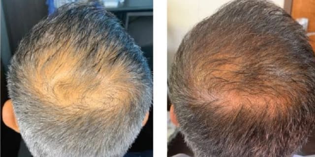 Hair Replacement Treatment