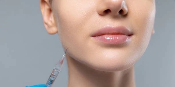One Syringe of Juvederm Ultra XC