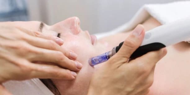 One Microneedling Treatment