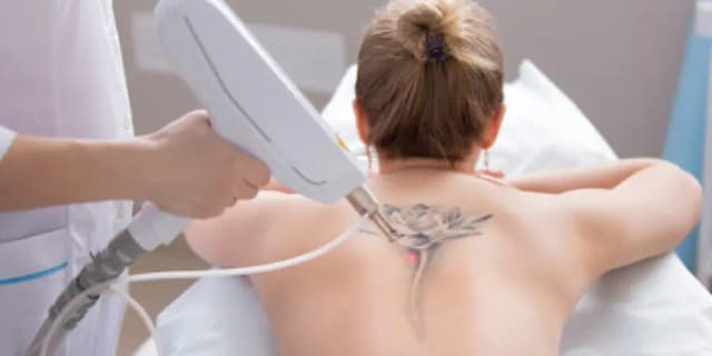 Tattoo Removal Services