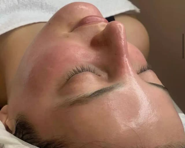 Two Medical-Grade Chemical Peels