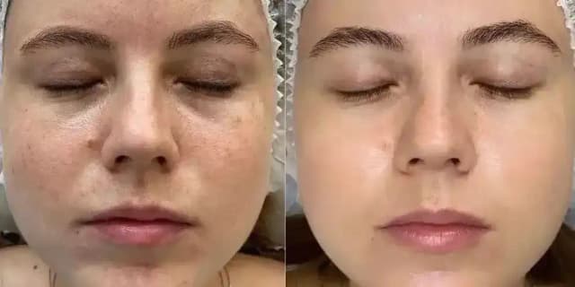 One Medical-Grade BioRePeel Chemical Peel
