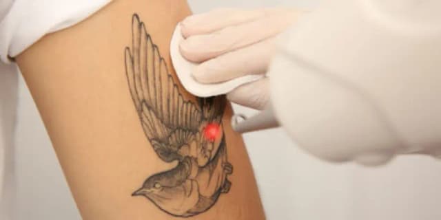 $100 Off Laser Tattoo Removal Services
