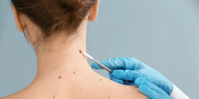 Up to Ten Skin Tag Removals