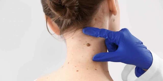 Up to Five Skin Tag Removals