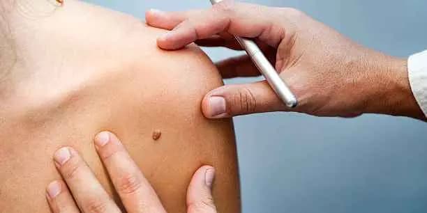 Up to Three Skin Tag Removals