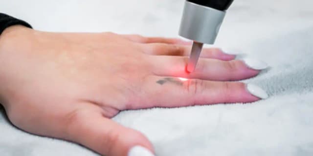 SMALL Area (Index Finger Size): THREE Laser Tattoo Removal Sessions