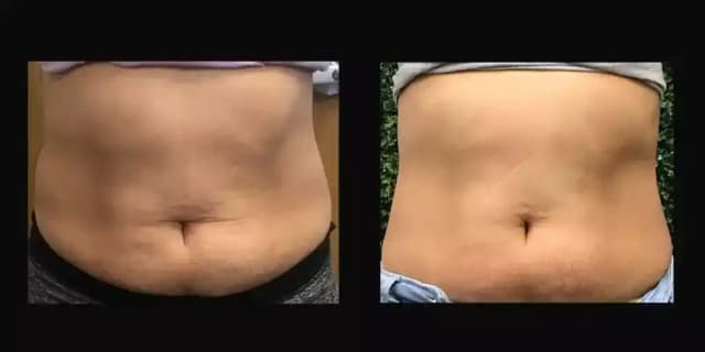 One Body Sculpting Treatment Non Surgical Lipo