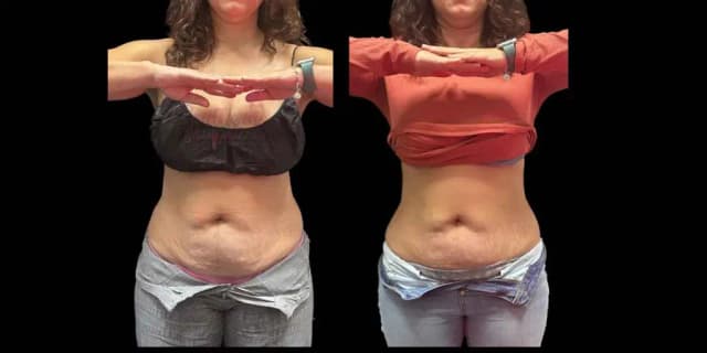 One Cellulite Treatment