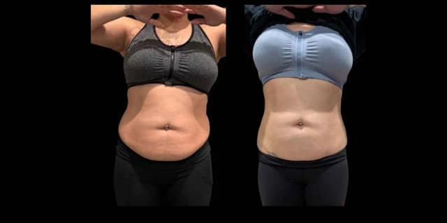 One Non-Invasive Needle Free Fat Dissolver or Skin Tightening Session