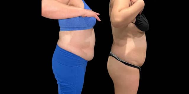 Two Non-Invasive Needle Free Fat Dissolver Sessions