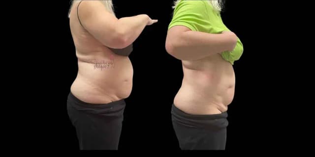 Three Non Invasive Fat Reduction Treatments