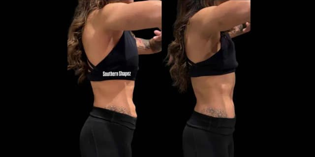 Three Radio-Frequency Skin-Tightening Treatments