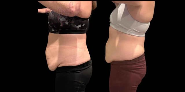 One Radio-Frequency Skin-Tightening Treatment