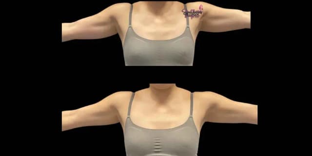 One Natural Fat Reduction Abdomen and Arms