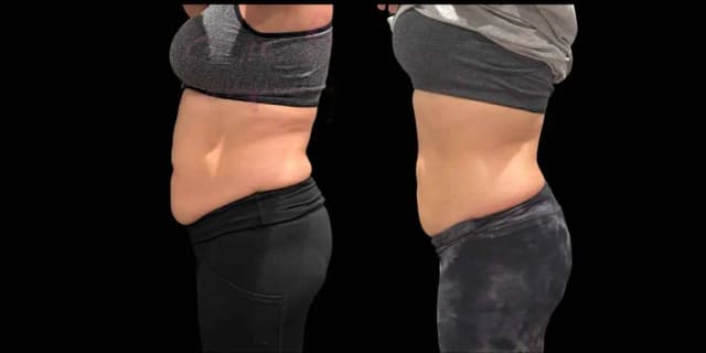 One Fat Reduction Body Sculpting Session