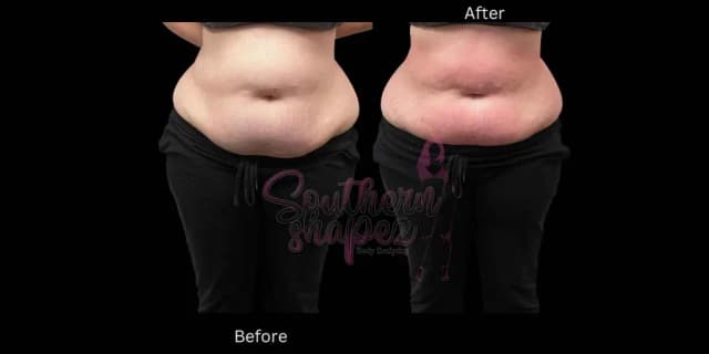 Five Ultrasonic Fat Reduction Cavitation Treatments