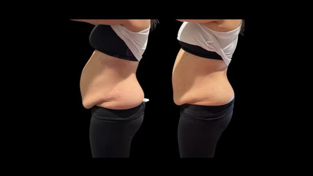 One Ultrasonic Body Sculpting Session