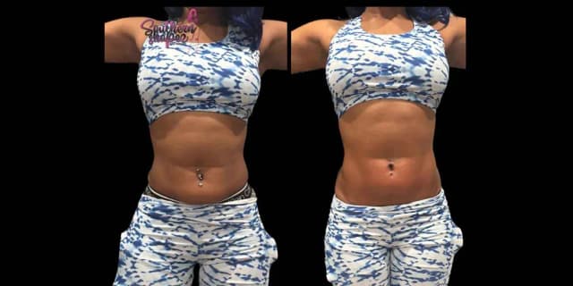 Non Invasive Skin Tightening Abdomen, Arms, Chin