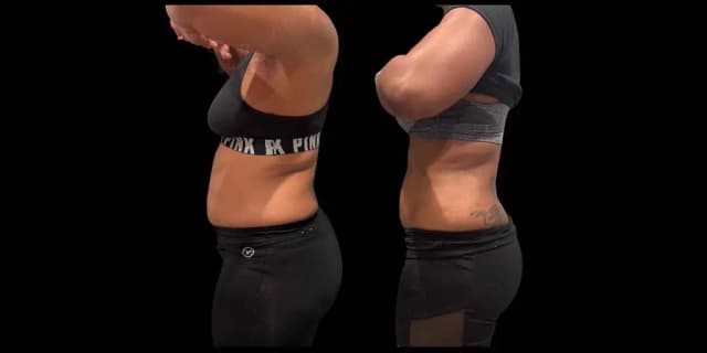 One Snatched 360 Ultrasonic Body Sculpting Session