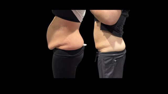 Three Ultrasonic Fat Reduction Cavitation Treatments