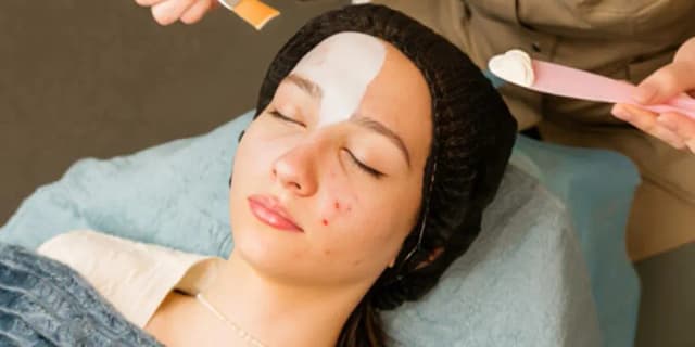 Get 10% off your Acne Treatment!