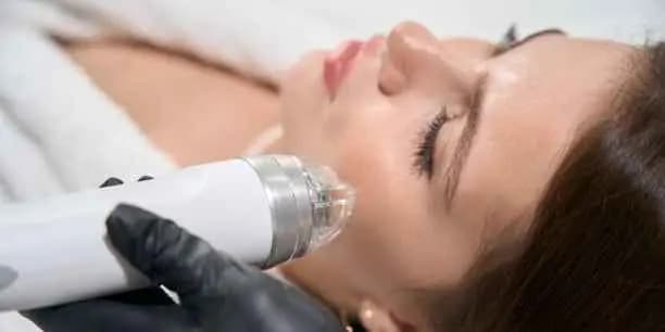 Microneedling Treatment