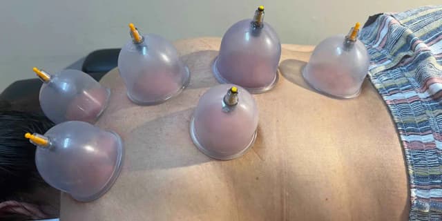 Cupping Therapy