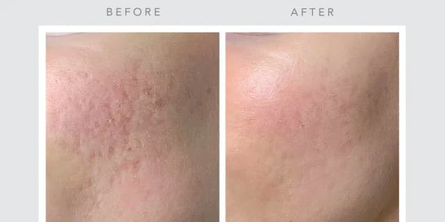 Memorial Day Special - Three Hyaluronic Acid Microneedling Treatment (AntiAge)