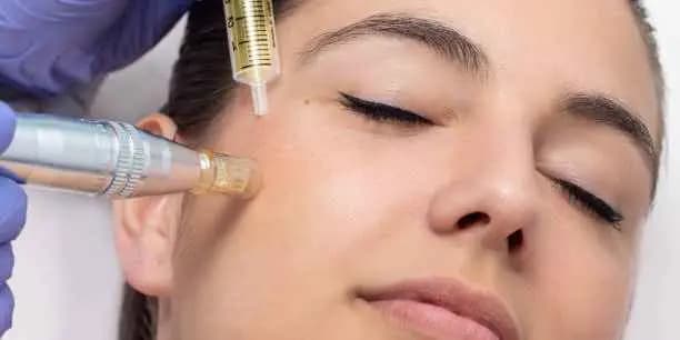 Hyaluronic Acid Microneedling Treatment (AntiAge)