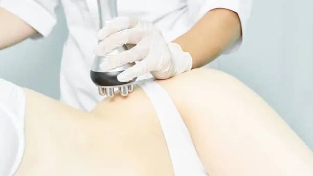 One 60-Minute Session of Ultrasonic Cavitation and Radiofrequency Treatment