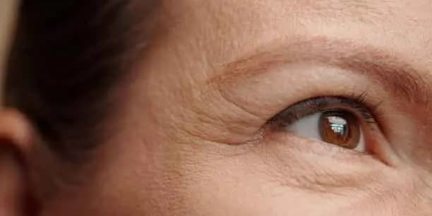 Plasma Fibroblast Treatment - Crow's Feet