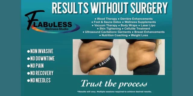Two Fat Dissolve Infusion Treatments (Non-invasive & Needle Free)