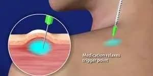 Trigger Point Therapy Injection