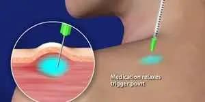 Trigger Point Injection