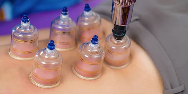 20-Minute Cupping Therapy