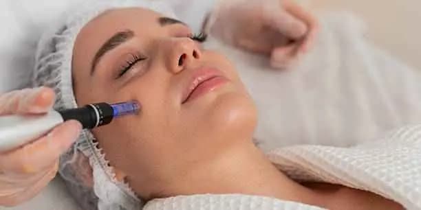 Three Microneedling Session