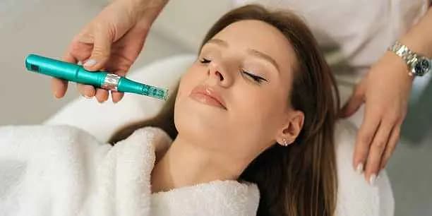 One Microneedling Session