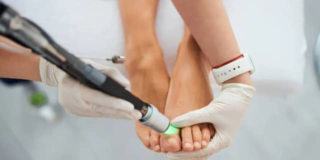 Laser Toenail Fungus Removal Treatment for One Foot
