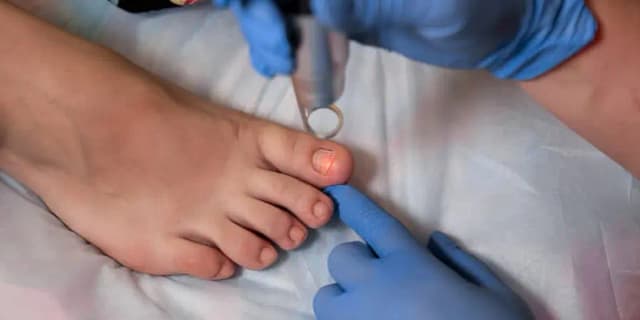 Laser Toenail Fungus Removal Treatment for Two Feet