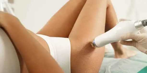 One Inkless Stretch Mark Reduction Small / Medium Area