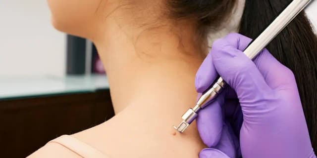 Up to 20 Skin Tag Removals