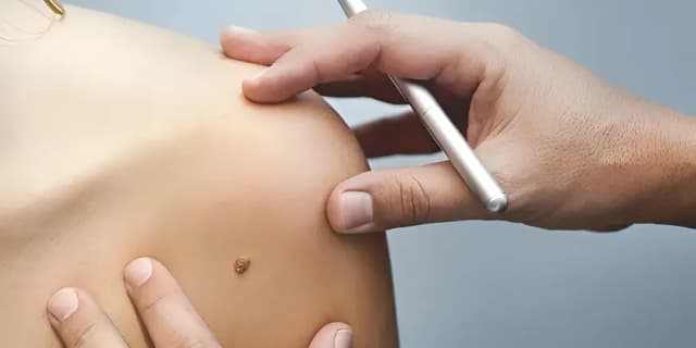 Up to 40 Skin Tag Removals