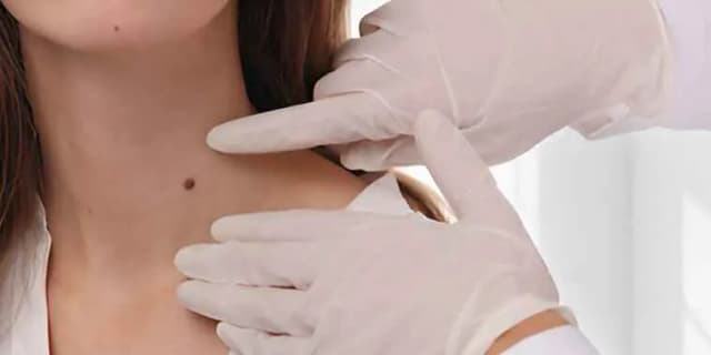 Up to 10 Skin Tag Removals