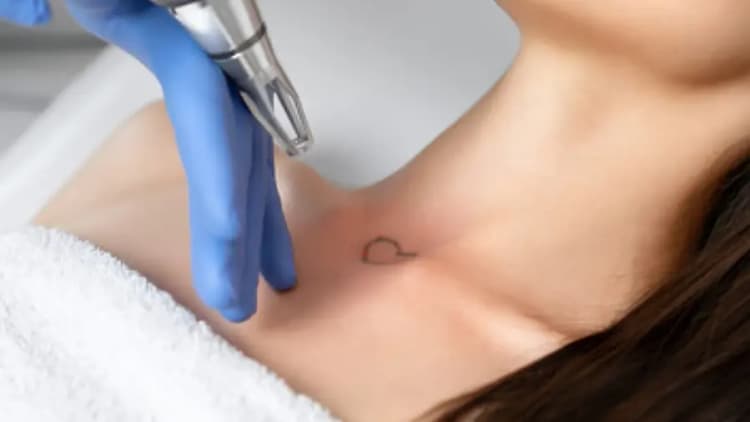 Tattoo Removal - Small