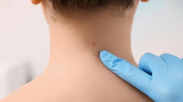 Skin Tag Removal - Up to 5