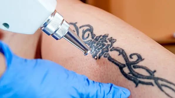 Tattoo Removal - Medium