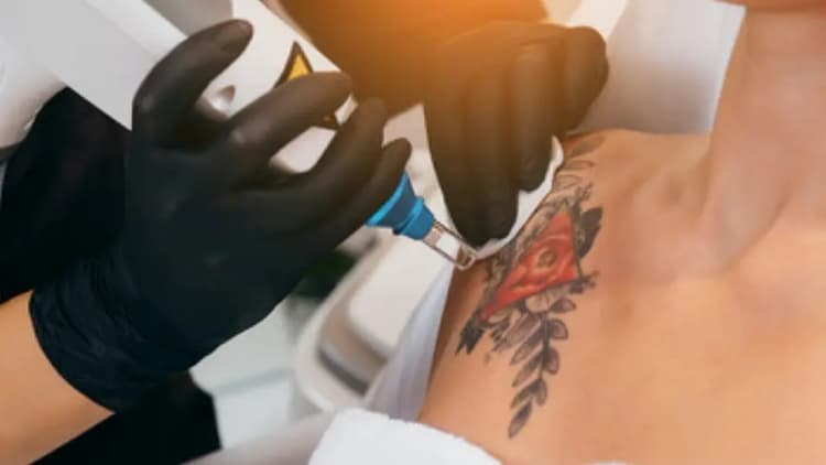 Tattoo Removal - XL