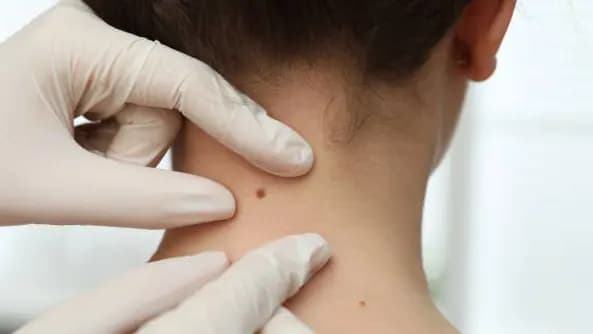 Skin Tag Removal - Up to 3